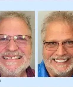 𝐇𝐢𝐝𝐨𝐧𝐞® –🦷Advanced Customized Full Denture Set🦷