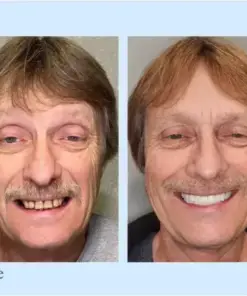 𝐇𝐢𝐝𝐨𝐧𝐞® –🦷Advanced Customized Full Denture Set🦷