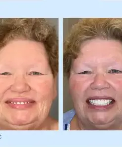 𝐇𝐢𝐝𝐨𝐧𝐞® –🦷Advanced Customized Full Denture Set🦷