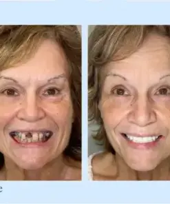 𝐇𝐢𝐝𝐨𝐧𝐞® –🦷Advanced Customized Full Denture Set🦷