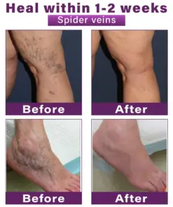 GFOUK® Polidocanol Nano Varicose Vein Patch