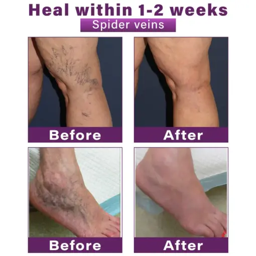 GFOUK® Polidocanol Nano Varicose Vein Patch