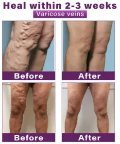 GFOUK® Polidocanol Nano Varicose Vein Patch