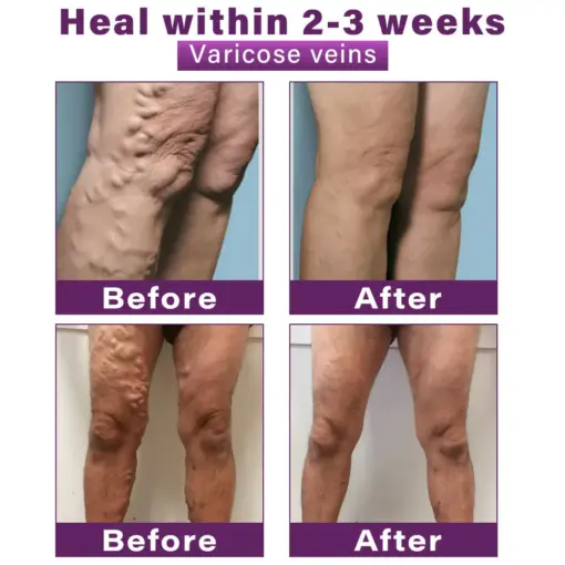 GFOUK® Polidocanol Nano Varicose Vein Patch