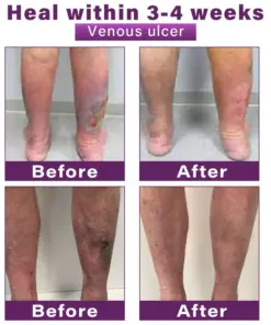 GFOUK® Polidocanol Nano Varicose Vein Patch