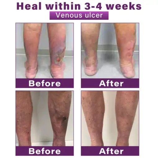 GFOUK® Polidocanol Nano Varicose Vein Patch