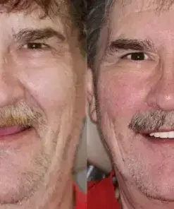 HZA™ –🦷Advanced Customized Full Denture Set