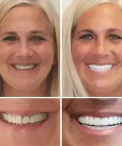 HZA™ –🦷Advanced Customized Full Denture Set