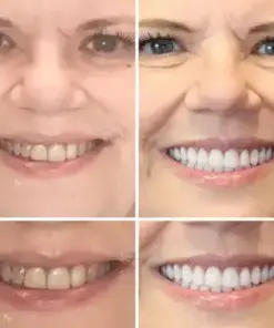 HZA™ –🦷Advanced Customized Full Denture Set