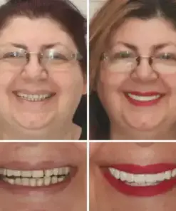 HZA™ –🦷Advanced Customized Full Denture Set
