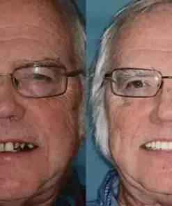 HZA™ –🦷Advanced Customized Full Denture Set