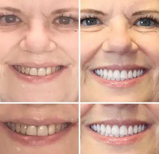 TAILEDEN™ - Premium Denture