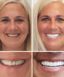 TAILEDEN™ - Premium Denture