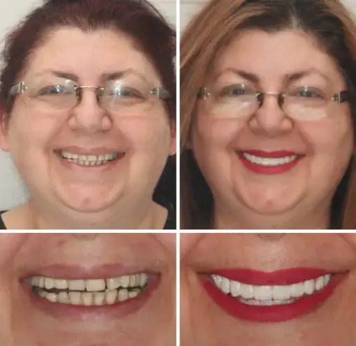 TAILEDEN™ - Premium Denture